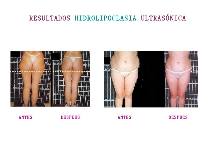 hidrolipoclasia ultrasonica antes y despues de adelgazar hidrolipoclasia ultrasonica antes y despues de adelgazar